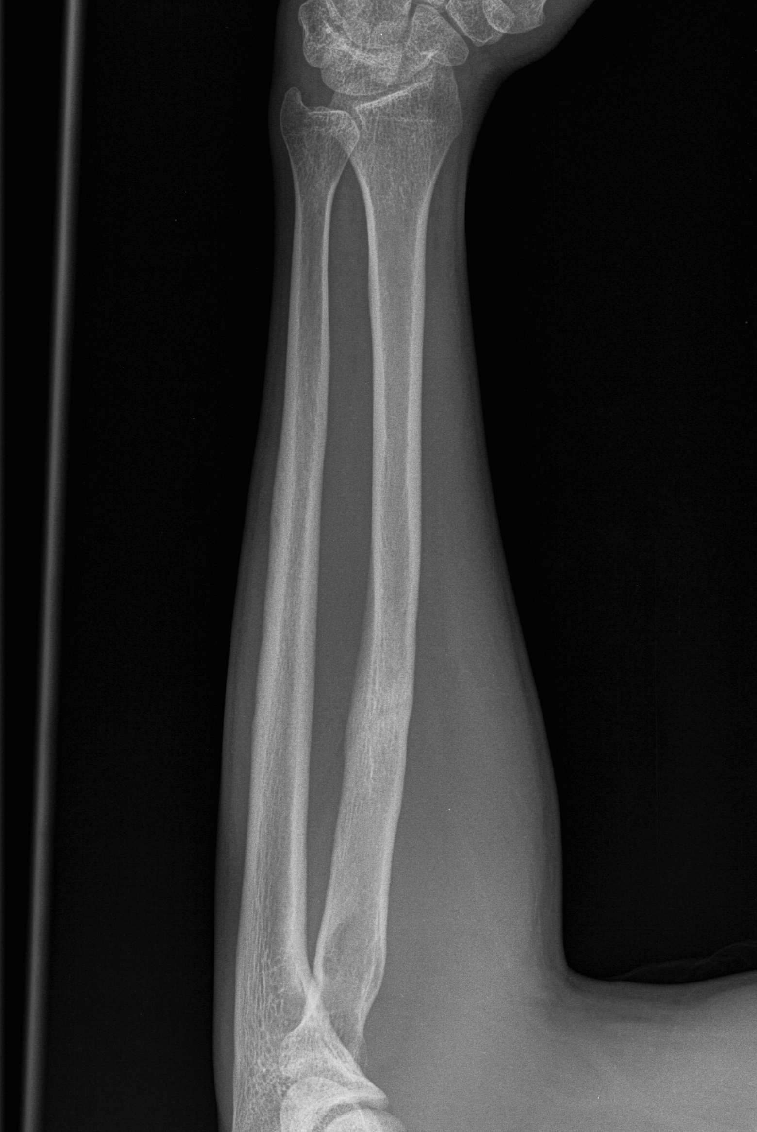 Radial Fracture Malunion 2